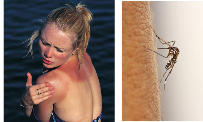 sunburn-insect-bite-remedies