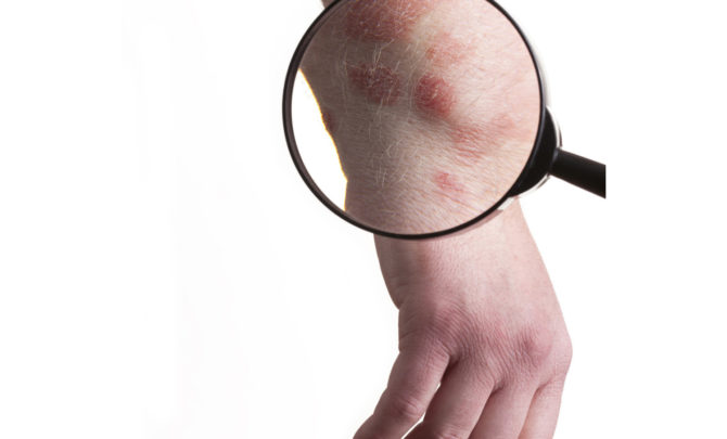 how-to-tackle-itchy-rashes